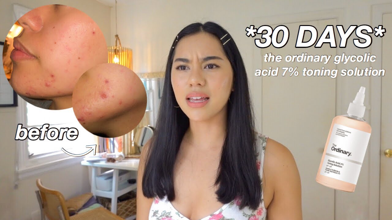 Watch The Ordinary Glycolic Acid 7% Toning Solution *30 Day Results* + Pictures Now The Ordinary Glycolic Acid 7% Toning Solution *30 Day Results* + Pictures