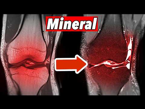A deficiency of this mineral removes knee cartilage💥(HERE'S HOW TO FIX IT)🤯