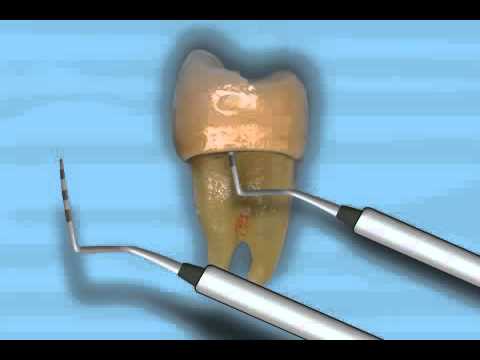 What is secondary caries - caries under the crown of the tooth?