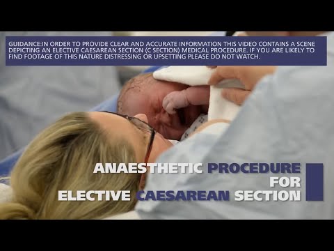 Anaesthetic procedure for elective caesarean section (C section)