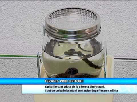 tratamentul vederii cu hirudoterapie