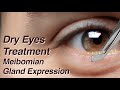 Dry Eyes Treatment with Meibomian Gland Expression (MGD)