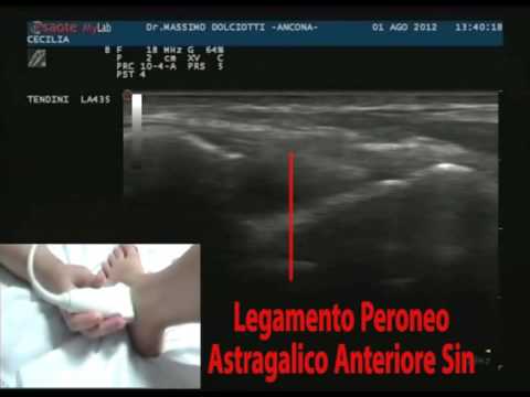 Caviglia Codice lesioni ICD Patate utilizzate nel trattamento dei giunti