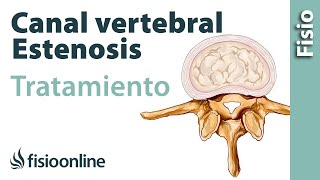 Estenosis de canal vertebral lumbar - Qué es y cómo se trata