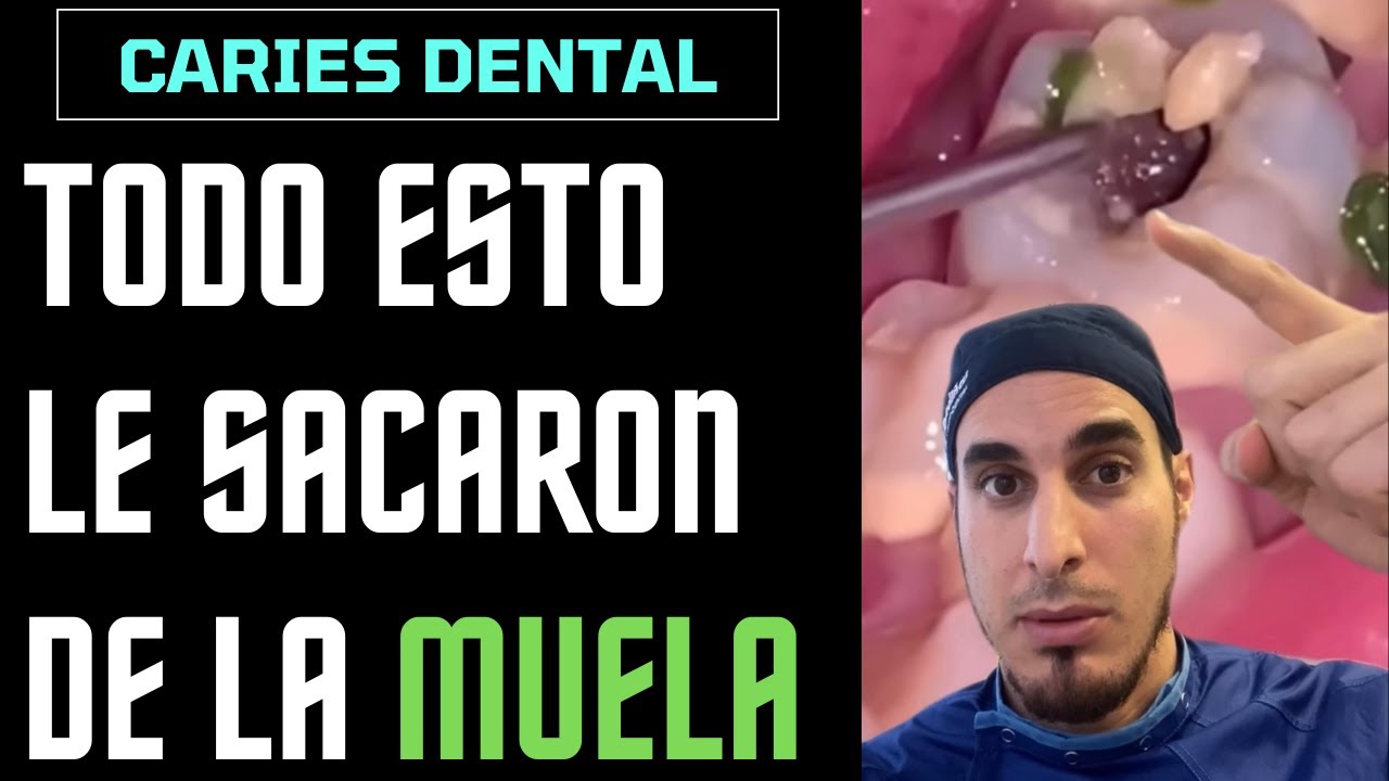 Watch ¿Qué es todo esto que le sale de un AGUJETO en la MUELA - CARIES DENTAL Now ¿Qué es todo esto que le sale de un AGUJETO en la MUELA - CARIES DENTAL