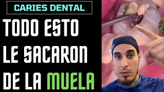 ¿Qué es todo esto que le sale de un AGUJETO en la MUELA - CARIES DENTAL