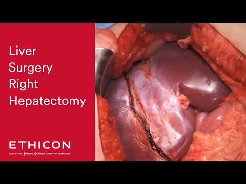 Peritoneal cancer vertaal