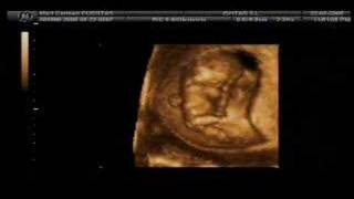 Ecografía 4D de un feto de 11 semanas - Samaranch Consulta Ginecológica