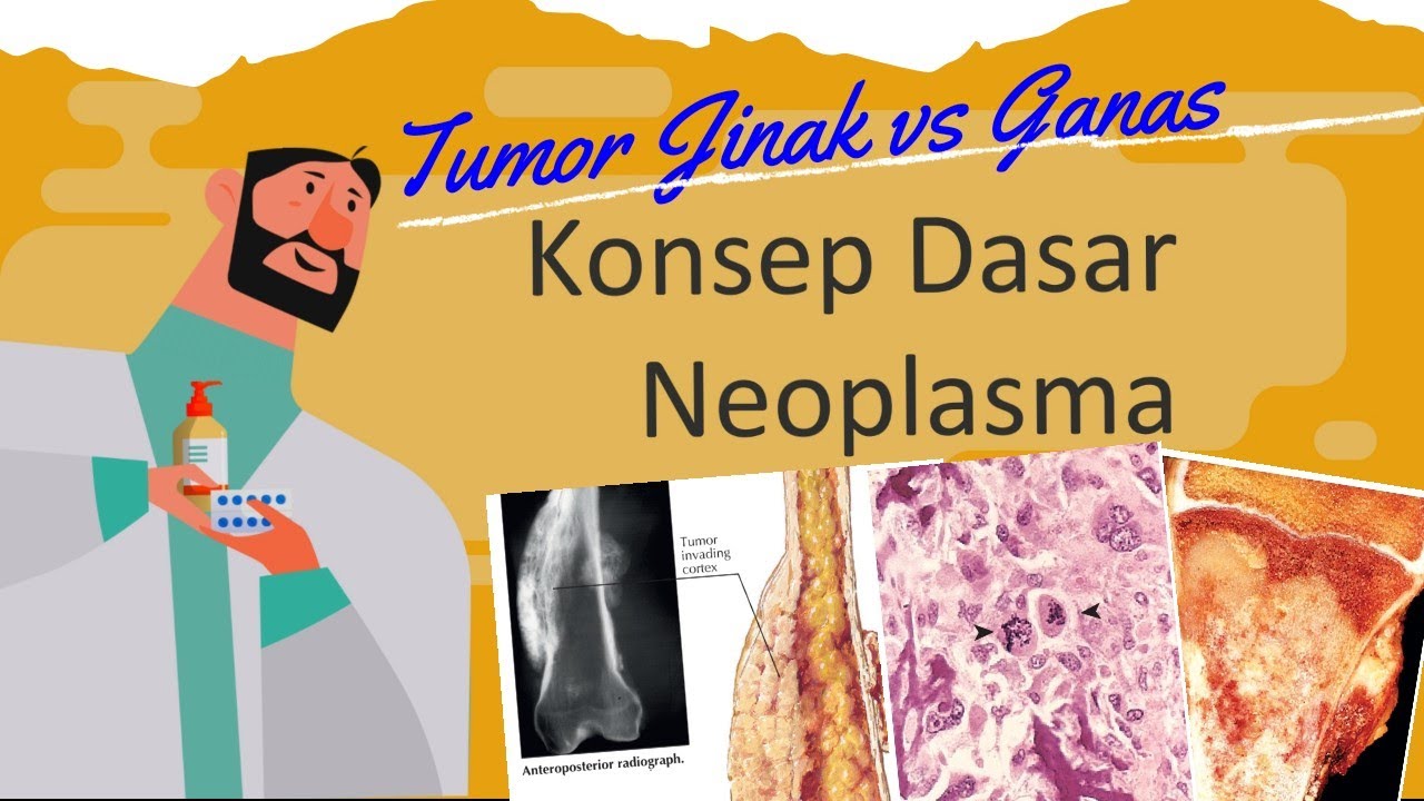 Konsep Dasar Patologi Anatomi : Tumor Neoplasma Jinak vs Ganas