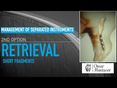 How to remove a broken file from the root canal (1)