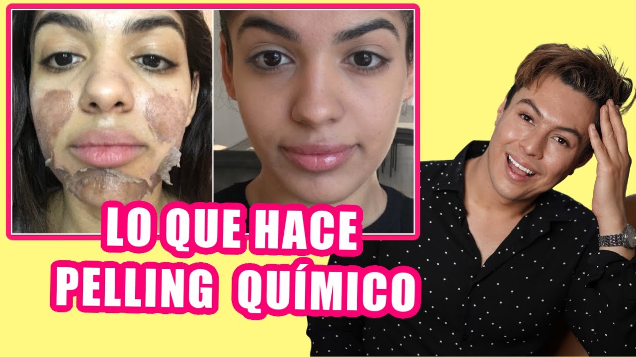 Lo Que Debes Saber Sobre Los Peelings Químicos | Yasmany
