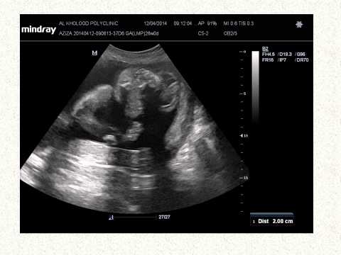 Case 11 Study fetal acrania