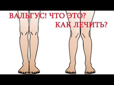 Вальгусная постановка ног / Как лечить