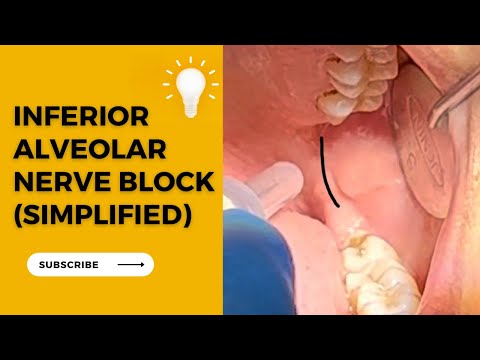 Inferior Alveolar Nerve Block (Step By Step)