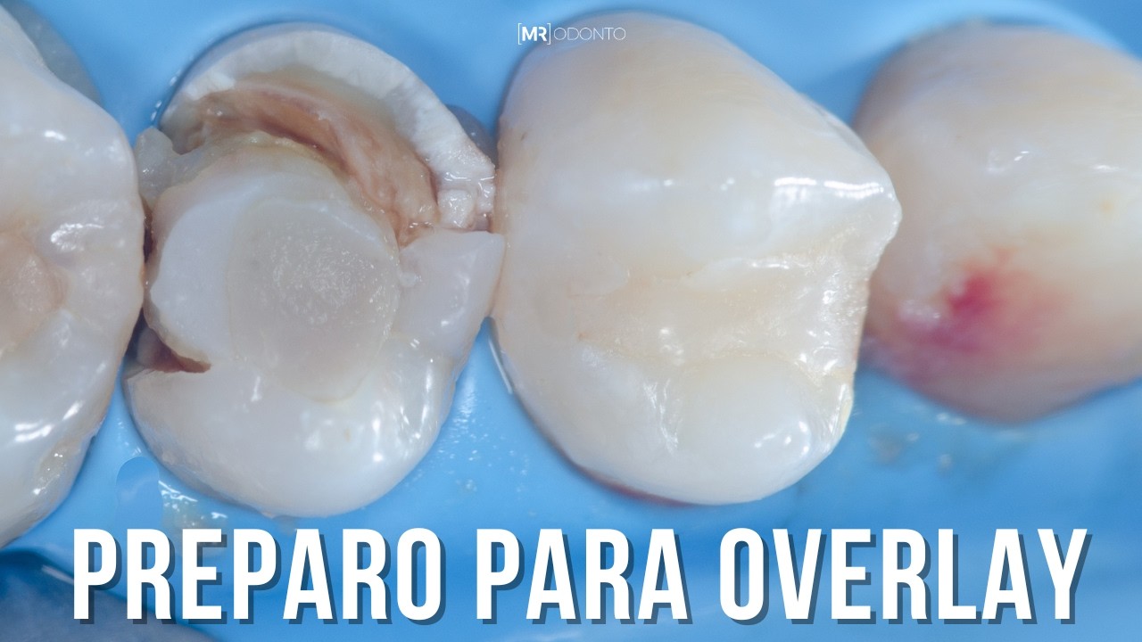 PREPARO PARA OVERLAY