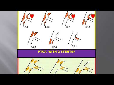 CORONARY ARTERY BIFURCATION LESION,INTERVENTIONAL TECHNIQUE.  KASTANIS BIFURCATIONS