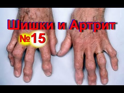 Аппарат для лечения суставов алмаг инструкция Нормальное положение шейного отдела позвоночника