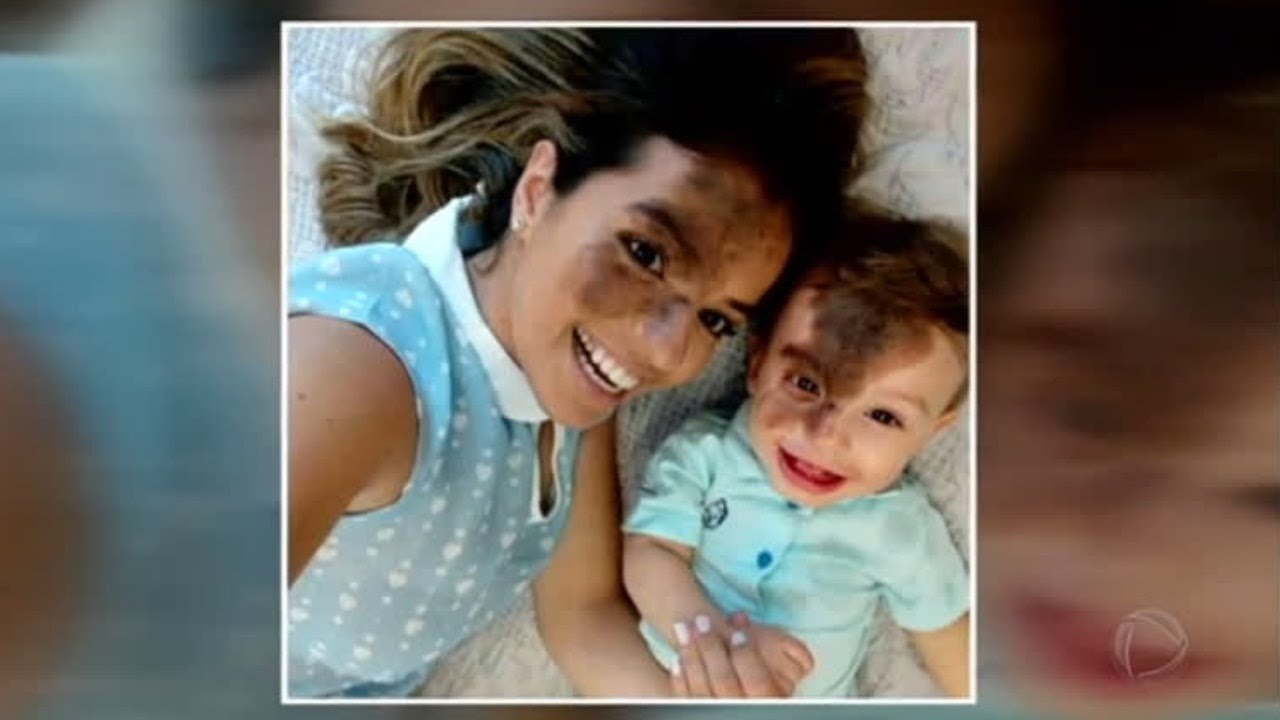 Mãe pinta o rosto em homenagem ao filho com mancha de nascença