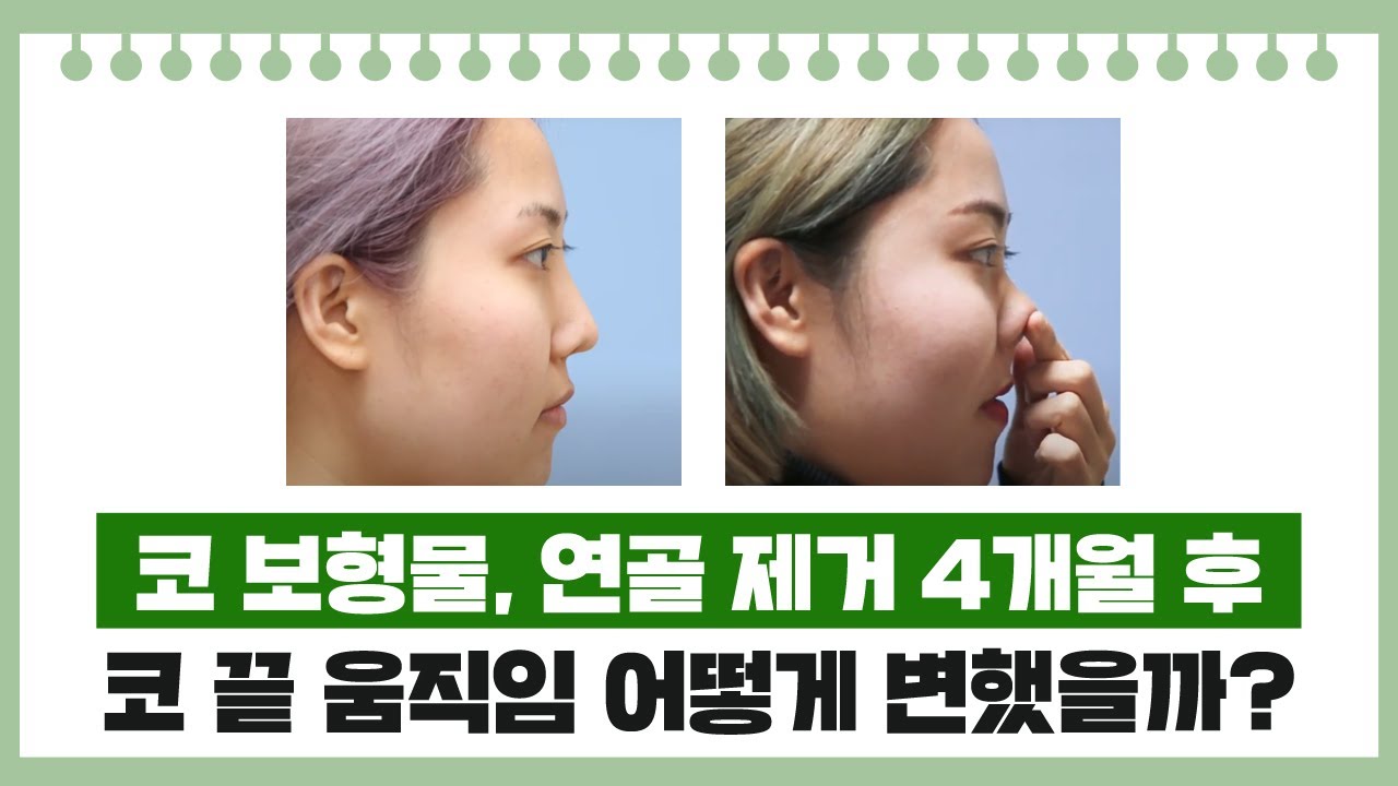 코보형물, 연골 제거 후 코끝의 움직임 사례 썸네일