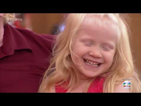 Encontro com Fátima Bernardes 04/12/2018 - Albinos sofrem discriminação por falta de informação