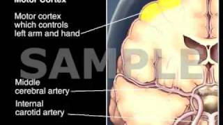 TIA and Stroke — Medical Animation