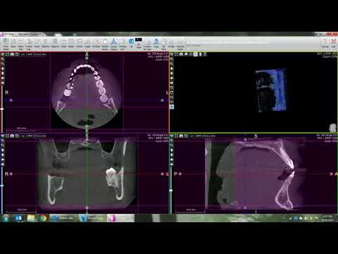 Volume Measurement in ACTEON Imaging Suite