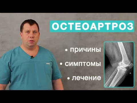 Остеоартроз. Причины, симптомы и лечение остеоартроза. Отличие артрита от остеоартроза