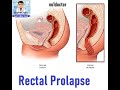 Prolapse Of The Rectum Causes Diagnosis Investigations Treatment Surgery Laparoscopy Mrcs Frcs