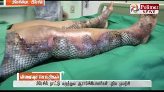 Brazil uses fish skin to treat skin scars ! | Polimer News | #FishSkinTreatment #Brazil video