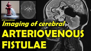 Imaging of Cerebral Arteriovenous Fistulae
