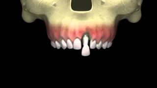 AnyRidge "FUSE" Provisional Abutment with POP-OFF Concept