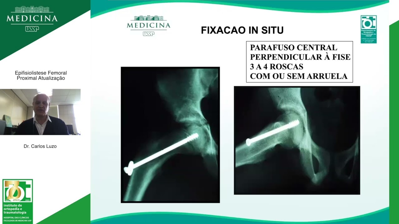 Epifisiolistese Femoral Proximal Atualização - Dr  Carlos Luzo