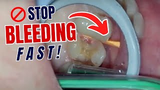 Hemostatic Oblique Wedge Technique - Stop Gingival Bleeding