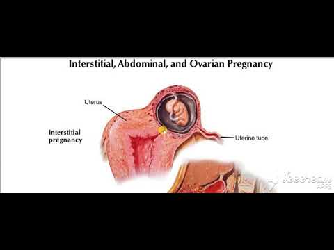 Ectopic pregnancy 2