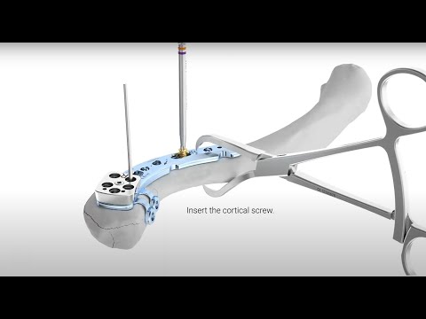 Surgical technique APTUS Clavicle Superior Lateral Plate