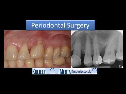 Periodontal Surgery with GTR - Before & After 7 Years