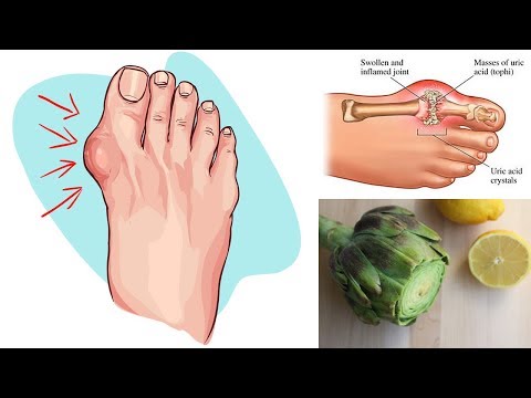 Eliminate Gout and High Uric Acid Levels With Artichoke and Lemon Water