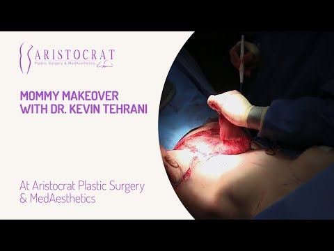 Mommy Makeover with Dr. Kevin Tehrani