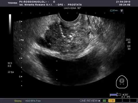 Prostata forum amanti di massaggio Operazioni rotonde sulla prostata e riabilitazione dopo queste operazioni