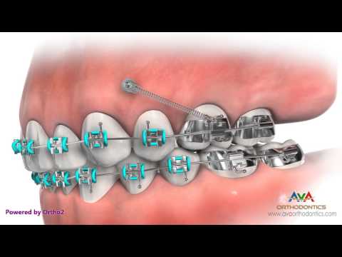 Temporary Anchorage Device or TAD - Orthodontic Appliance