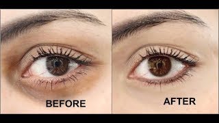 NO.1 Remedy to Remove Dark Circles OVERNIGHT