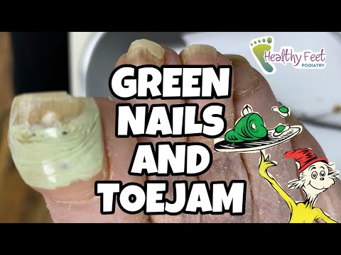 GREEN NAILS AND TOEJAM! CUTTING LONG, THICK, GREEN TOENAILS!