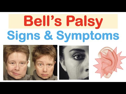Bell’s Palsy (Facial Paralysis) Signs & Symptoms (& Why They Occur)