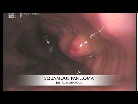 Papilloma schneiderian nasal