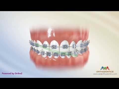 How to Wear Rubber Bands - Midline Upper 3 Lower 3