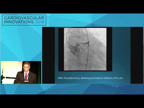 CVI2018 Session: TAVR complication success - Steven Yakubov, MD