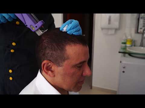 Mesoterapia para alopecia por Dr. Giovanni Bojanini el mejor dermatólogo en Bogotá.