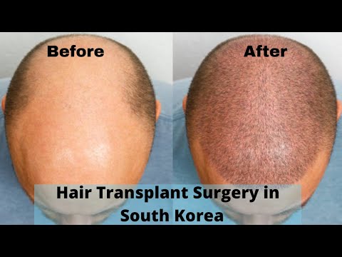 Why Choose South Korea for Hair Transplant? Hair...