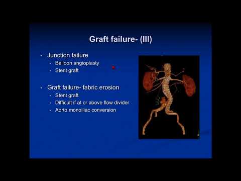 Treatment of Endoleaks: When and How to Intervene - Norman Kumins, MD