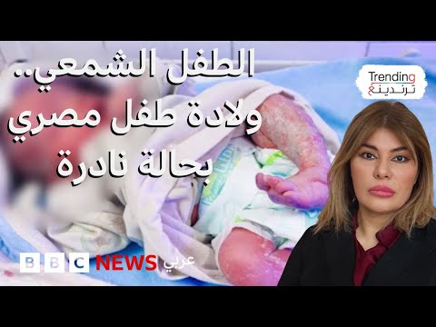 فيديو | ولادة نادرة لطفل "شمعي" في مصر.. ماذا نعرف عن هذا المرض؟